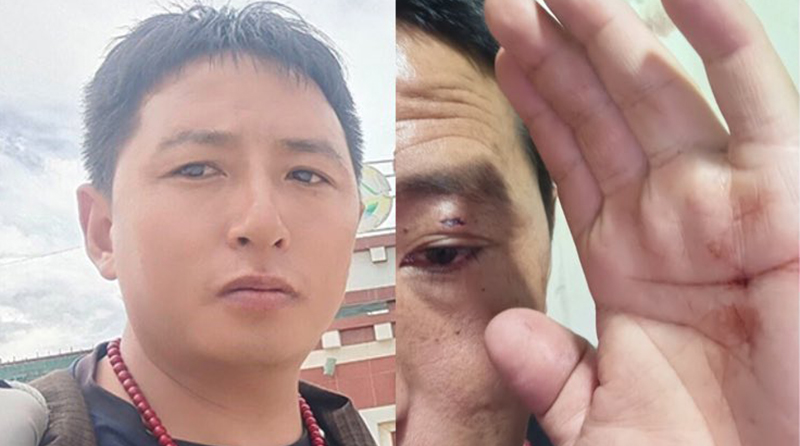Photo of former Tibetan political prisoner and Tibetan language advocate, Tashi Wangchuk, and photo of the injuries he sustained to his face and hands after being beaten. (Photo: file)